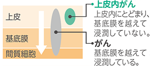 上皮内がん：上皮内にとどまり、基底膜を越えて浸潤していない。 がん：基底膜を越えて浸潤している。