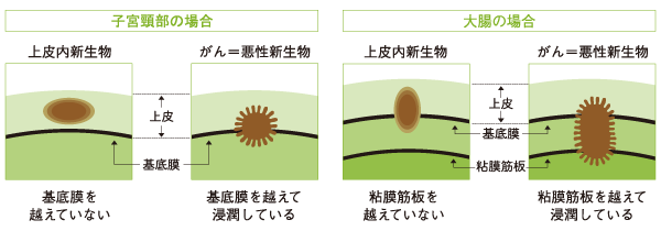 上皮内新生物について
