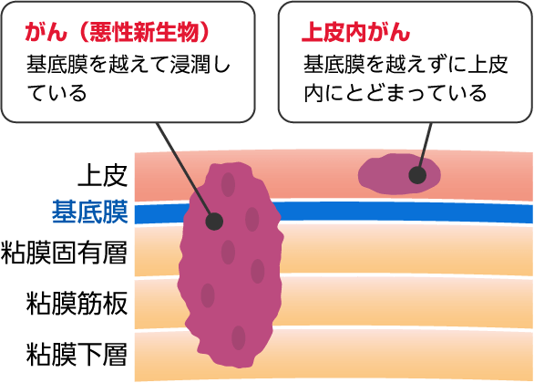 「上皮内がん」とはイメージ図